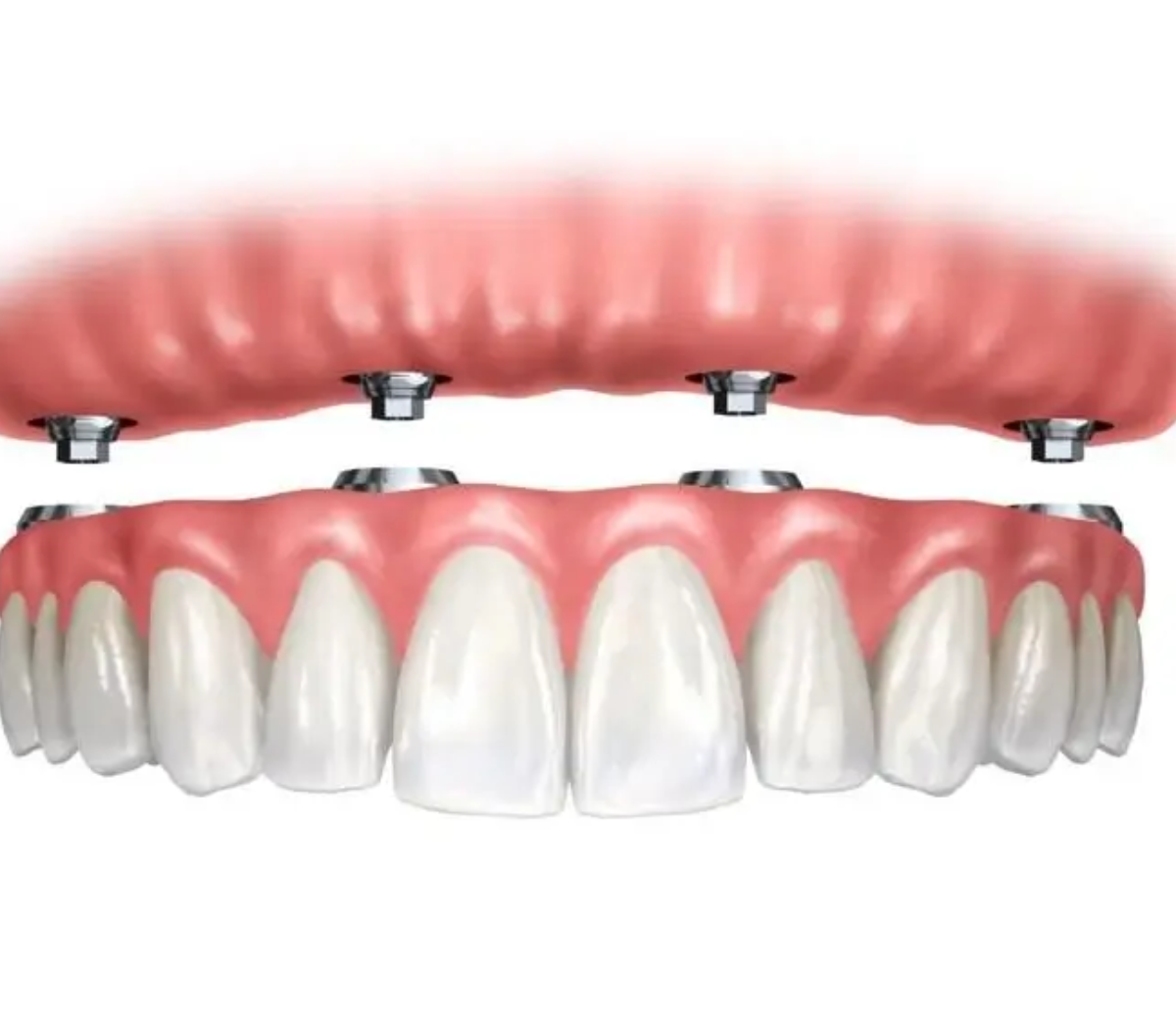 All in 4 Remplacer toutes les dents d'une arcade grâce à 4 implants dentaires supportant un bridge fixe complet.