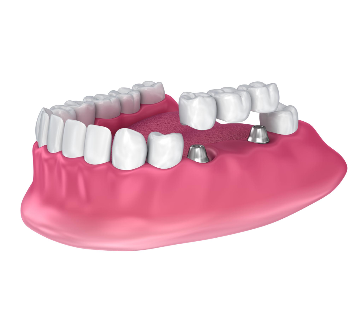 Bridge sur Implant Remplacer une ou plusieurs dents manquantes en s'appuyant sur des implants dentaires, plutôt que sur les dents naturelles adjacentes.