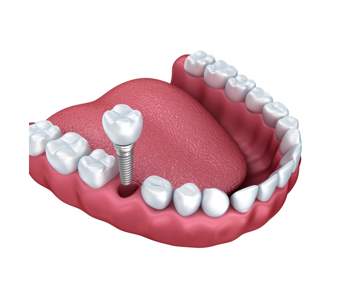 Implant unitaire Remplacement précis d’une dent absente avec un résultat naturel et parfaitement intégré.