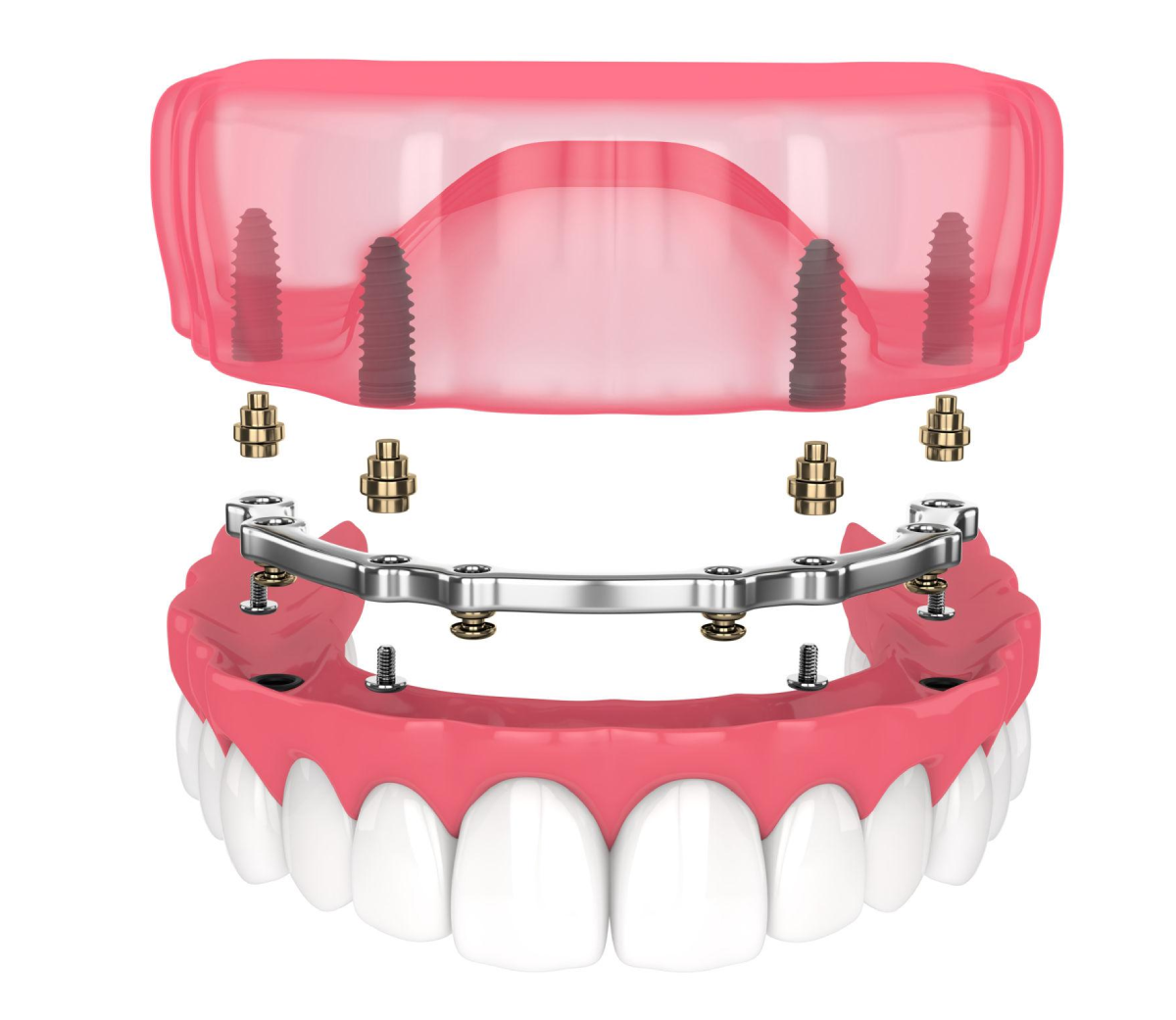 PACSI sur Implant Il s'agit d'une prothèse complète amovible (dentier) stabilisée et retenue par des implants dentaires.