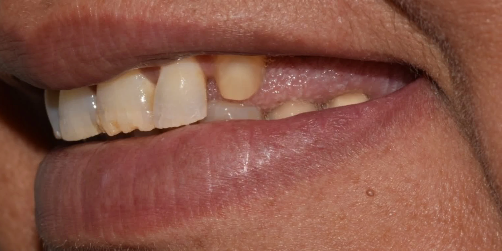 bridge sur implant avant